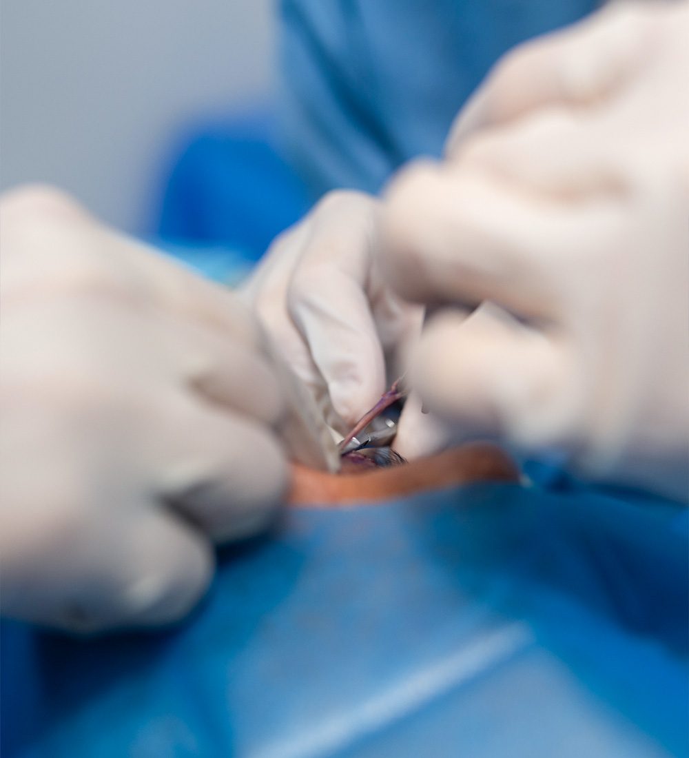 blefaroplastia